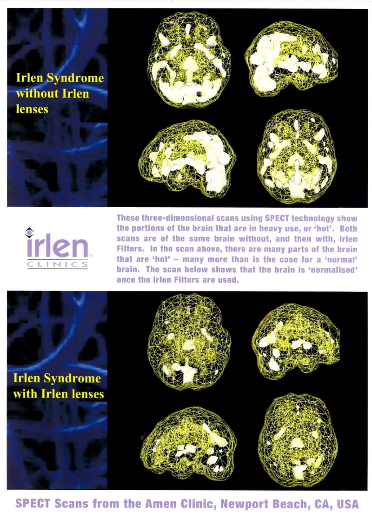Brain Activity & Irlen Syndrome - Irlen Diagnostic Clinic